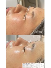 クレヴィー(Creviy)/韓国式3D毛穴洗浄＆REVlハーブ