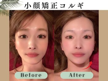 スイスパ 恵比寿(翠SUI SPA)/【小顔矯正コルギ】Before/After