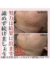 アルムダアクア 天王寺店(Aleumda AQUA)/ハーブピーリング/大阪/天王寺