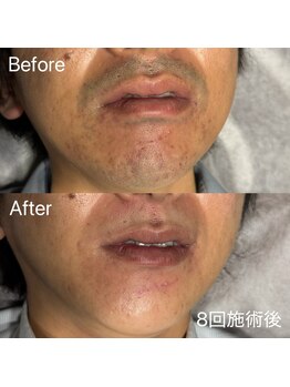 エピノン 山口岩国店(Epinon)/顔脱毛 ビフォーアフター