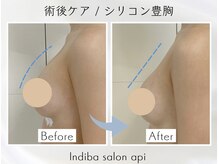 アピ(api)/症例写真【インディバ】