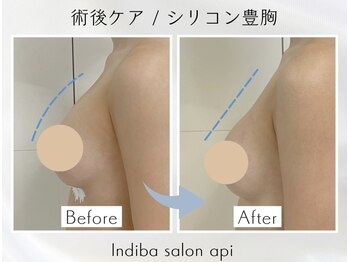 アピ(api)/症例写真【インディバ】