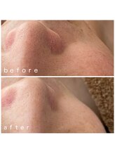 メナードフェイシャルサロン 岐阜茜部/ビタミンパックで透明感