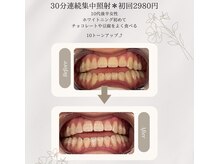 プラスビーセルフ(+b self)/ホワイトニングビフォーアフター