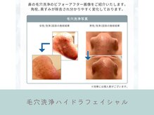 G/Hボディメイキング/毛穴洗浄ハイドラフェイシャル★