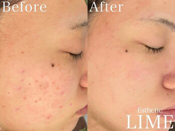 ライム 名古屋(LIME)/ハーブピーリング|ニキビケア