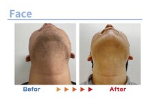 キングスサロン 熊本/メンズ髭脱毛ビフォーアフター