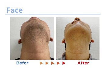 キングスサロン 熊本/メンズ髭脱毛ビフォーアフター