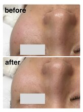 リヴィア(LIVIA)/毛穴・頬の赤みを一層！