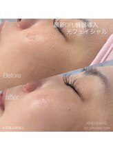 プリンセスローズ 焼津店(Princess Rose)/光フェイシャル