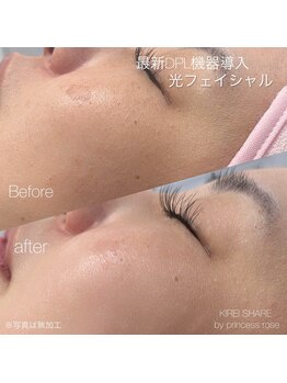 プリンセスローズ 焼津店(Princess Rose)/光フェイシャル