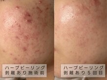 育肌美研 自由が丘サロン/ニキビケア｜ハーブピーリング