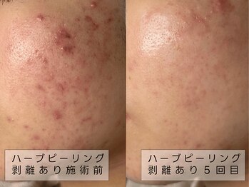育肌美研 自由が丘サロン/ニキビケア|ハーブピーリング