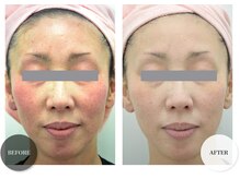 エムグランデ(Mgrande)/モナリ磁気パックで艶々美肌に♪