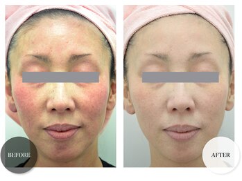 エムグランデ(Mgrande)/モナリ磁気パックで艶々美肌に♪