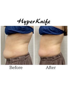 ハリルル 併設 GLケンタ鍼灸整骨院(HARILULU)/ハイパーナイフ