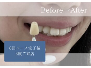 ホワイトニングカフェ 平塚店(WhiteningCafe)/◎歯のホワイトニング施術写真◎