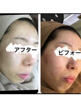 モッカ 北花田/顔フェイシャル　　ニキビケア