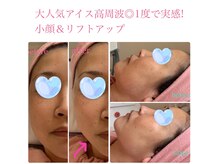 リッチアンビューティー(Rich.an beauty)の雰囲気（効果速実感フェイスラインリフトアップ☆お肌が元気に若々しく♪）