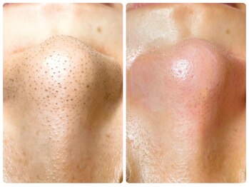 ピエル 柏店(PIEL)の写真/【いちご鼻卒業!】話題の毛穴エクストラクションで毛穴のお悩みを改善◎毛穴がクリアになり肌トーンUP![柏]