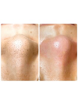 毛穴ケアをしたい