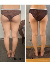 ラムールボーテ(L'AMOUR BEAUTE)/魅せる脚になりたい