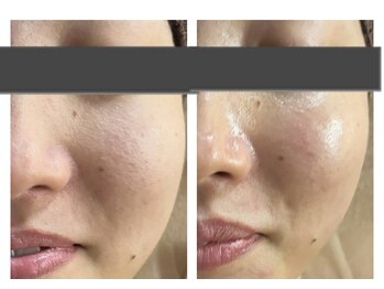 ザ ワン(THE ONE)/【ハーブピーリング】効果