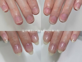 ミンスネイル(Mins Nail)/自爪育成半年後変化