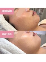 リシェル(Richelle)/ 【GREENPEELメラウェーブ】