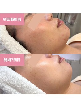 リシェル(Richelle)/ 【GREENPEELメラウェーブ】