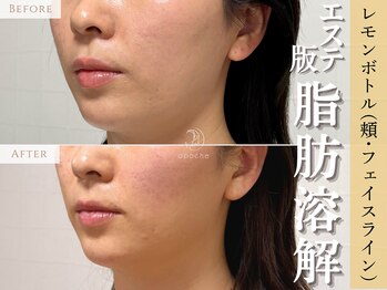 アポシェ(apoche)/小顔/輪郭形成/もたつき/脂肪