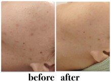 キュート 川越店(Cute)/ハーブピーリング【ソフト】