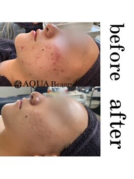 ビーエスアクアビューティー/リベルピーリング