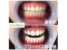 ルブラン 奈良店(Le Blanc)/虫歯、口臭予防にも！