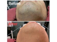 ナナラ(nanala)/エピアス脱毛器の効果