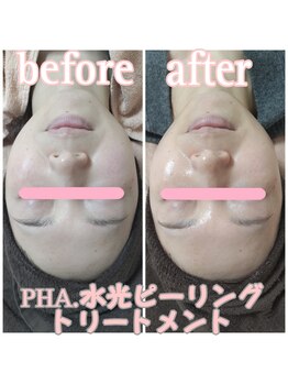 ピュルテ/水光ピーリングトリートメント