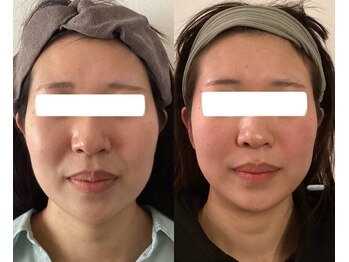 エムズサロン(m’sサロン)/初回→6回のビフォーアフター