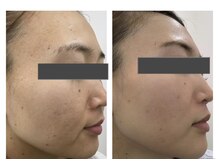 ザ ワン(THE ONE)/リアボーテ化粧品　BEFORE AFTER