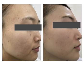 ザ ワン(THE ONE)/リアボーテ化粧品 BEFORE AFTER