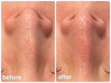 ルアナ(Luana)/人気のハイドロ毛穴洗浄☆