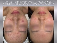 ハウピア(Haupia)/当店で肌質改善成功