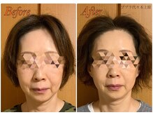 ブプラ 代々木上原店(BUPURA)/小顔×たるみ改善