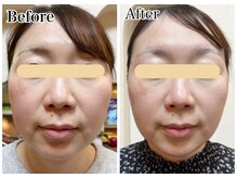 エステサロン ロータス(Lotus)の雰囲気（引き締まった小顔へ。シャープなフェイスラインへ変化。）