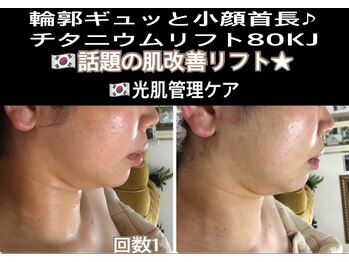 アルページュ(Arpege)/ギュッ輪郭チタニウムリフト80KJ