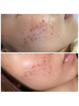 ポアレ(POARE)/施術1回の変化ハーブピーリング