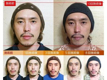 コカロ 豊川店(KOKARO)/《メンズ小顔MENU》 小顔コルギ