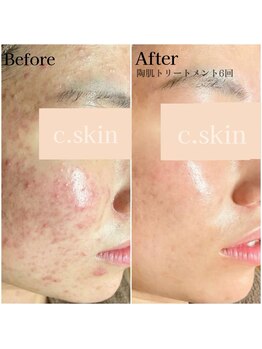 シースキン 盛岡駅前店(c.skin)/お客様ビフォーアフター