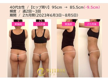 キングスサロン 熊本/美尻イスビフォーアフター