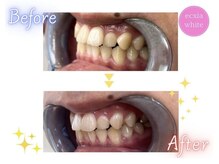エクシアホワイトニング エミフルMASAKI店/ホワイトニングビフォーアフター