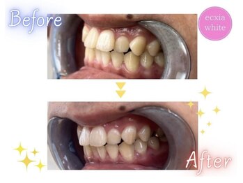 エクシアホワイトニング エミフルMASAKI店/ホワイトニングビフォーアフター